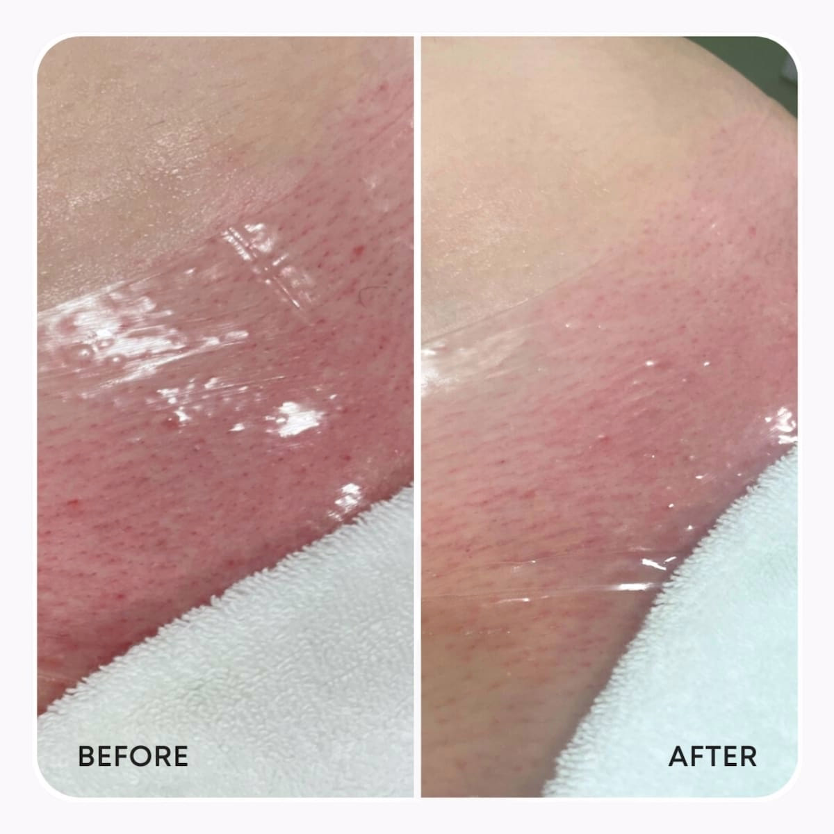 Hydrogel Vajacial Mask for Post Hair Removal Redness