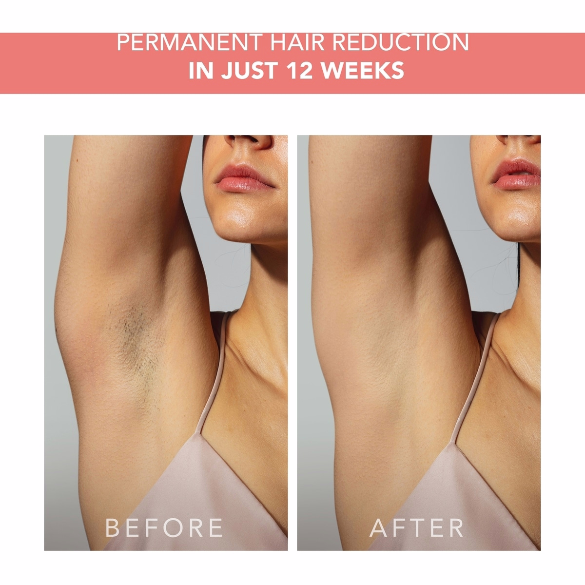 PEACH™ 2 피치 고급 IPL 제모 기기 PEACH™ 2 피치 고급 IPL 제모 기기