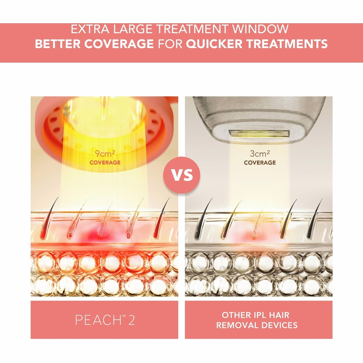 PEACH™ 2 피치 고급 IPL 제모 기기 PEACH™ 2 피치 고급 IPL 제모 기기