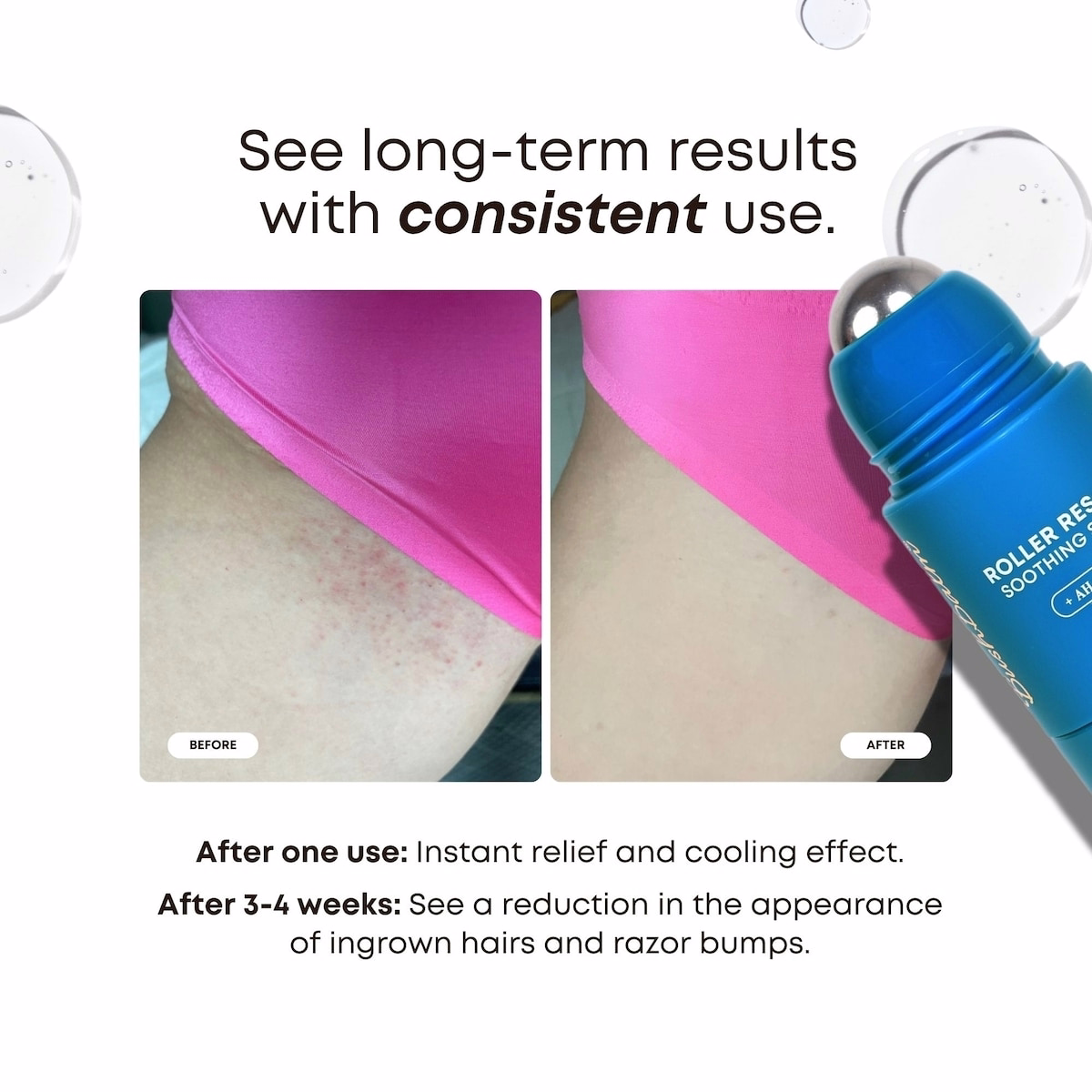 Roller Rescue Soothing Serum for Ingrown Hairs & Bumps Roller Rescue Soothing Serum for Ingrown Hairs & Bumps