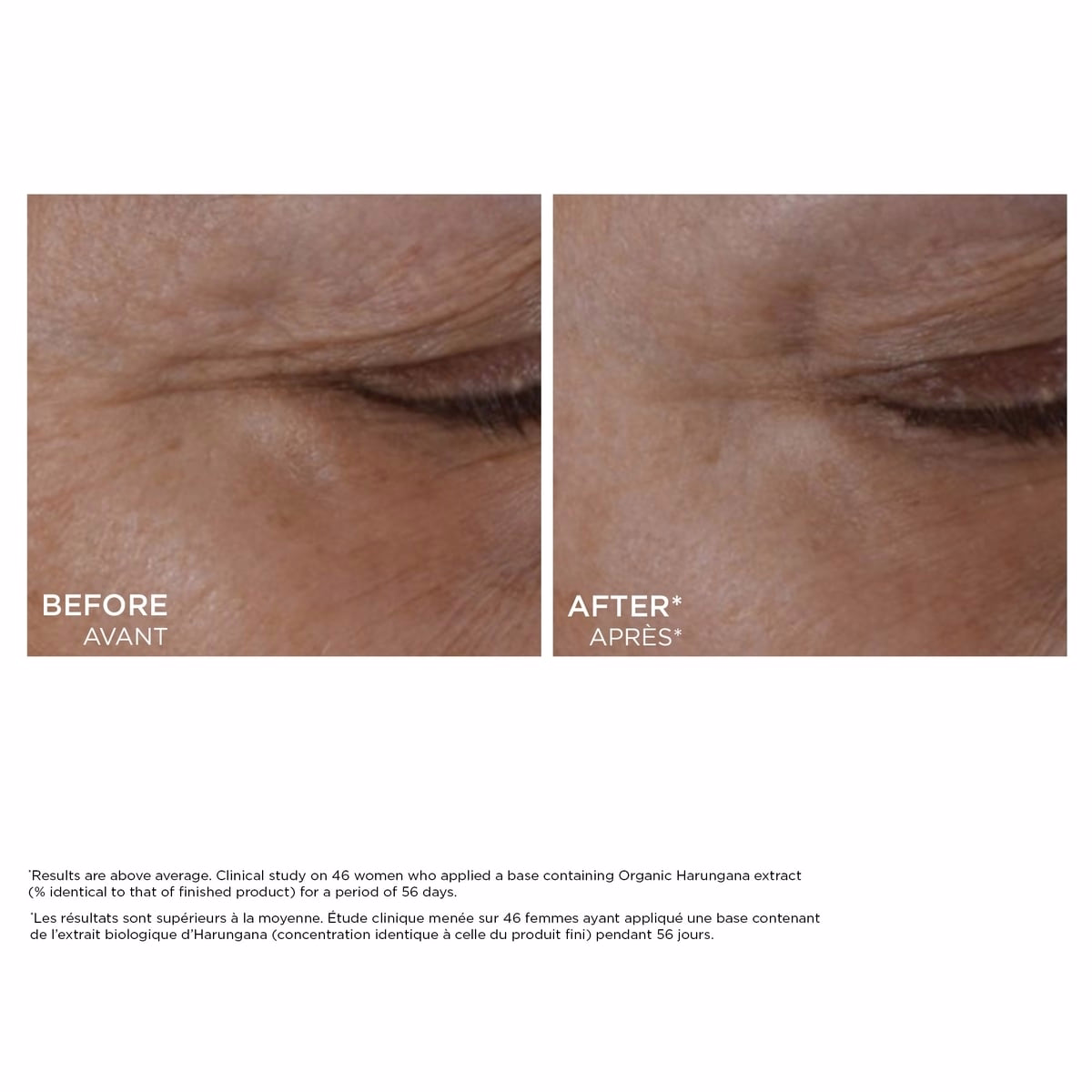 Total Eye Lift
